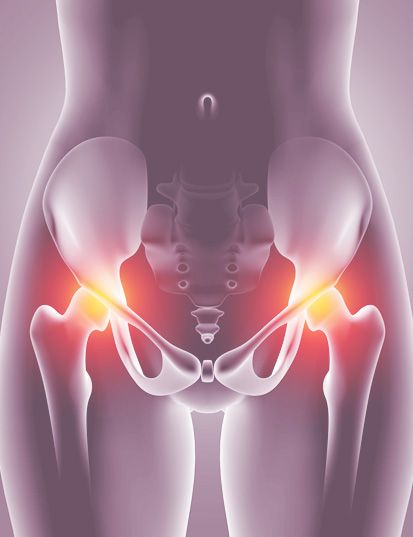 artritis en la cadera mujer