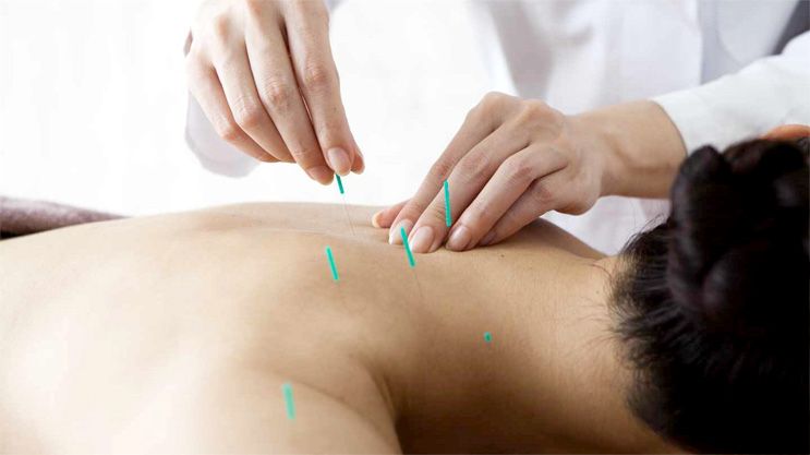 servicio profesional de acupuntura kynesit fisioterapia