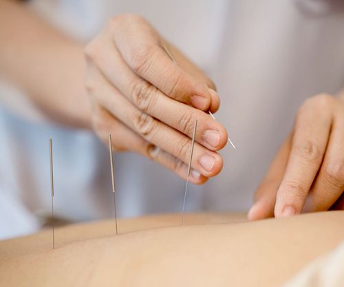 servicio de acupuntura 3 kynesit fisioterapia